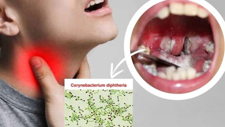 Dấu hiệu bị bệnh bạch hầu và cách phân biệt bệnh bạch hầu với viêm họng