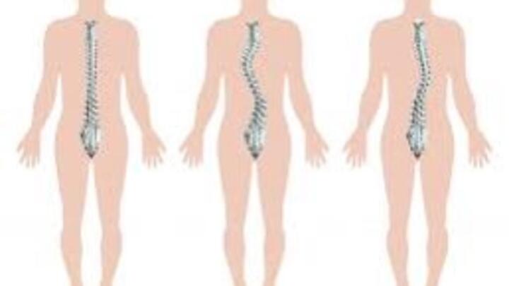 CONG VẸO CỘT SỐNG HỌC ĐƯỜNG