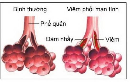 Hình ảnh phế quản bình thường và phế quản bị viêm.